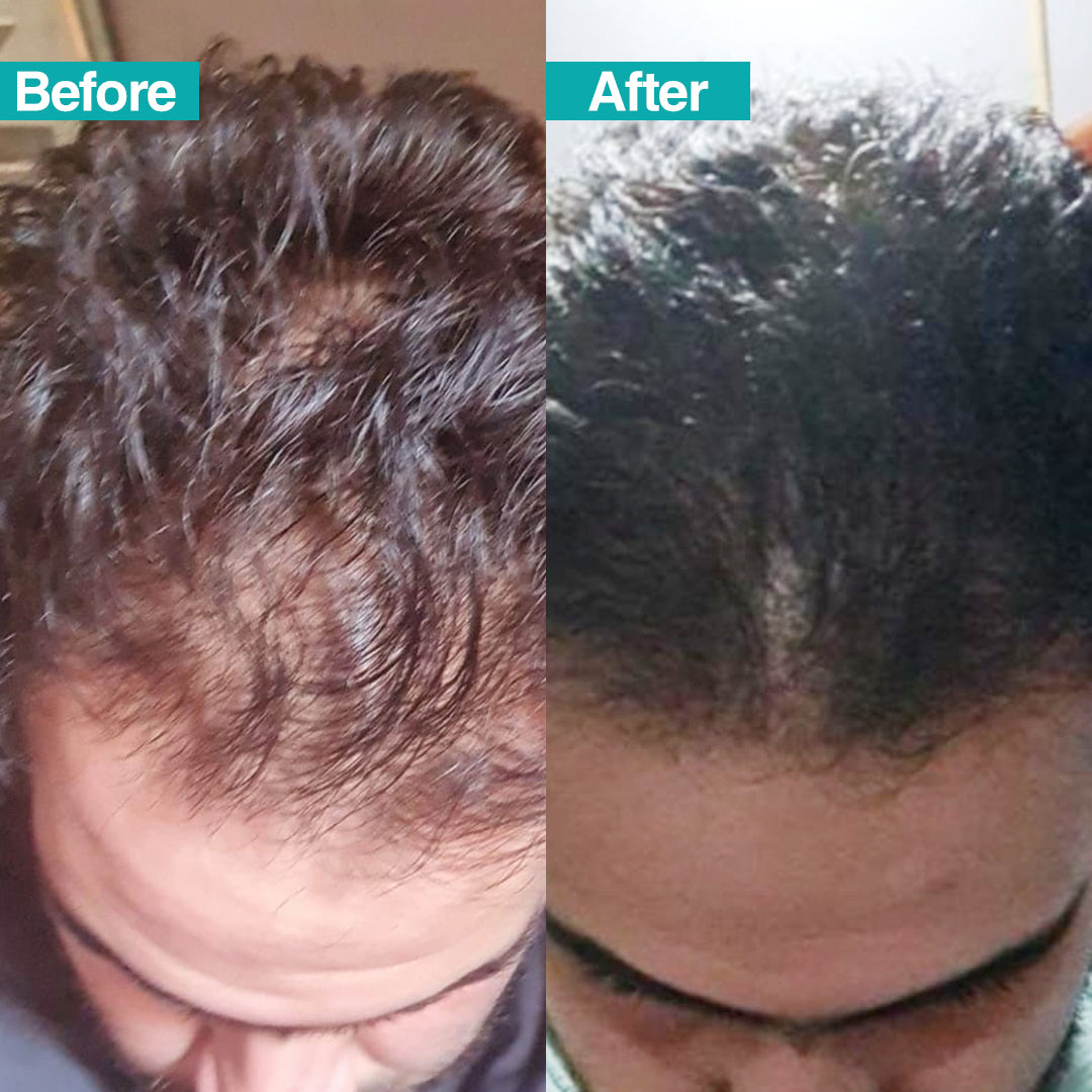 HairActCare Anti-Hair Loss spray Lotion